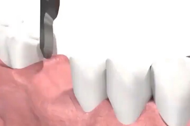 Как происходит установка зубных имплантов