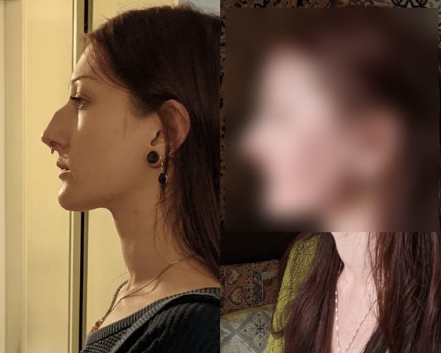 "До и после": люди, которые решились на пластическую операцию и не пожалели