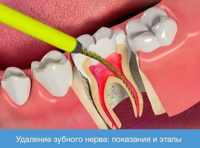 Показания и противопоказания к удалению нерва зуба