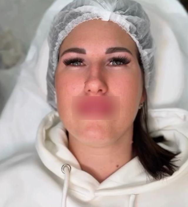 Заячья губа — новый тренд девушек у косметологов Заячья губа — новый тренд девушек у косметологов