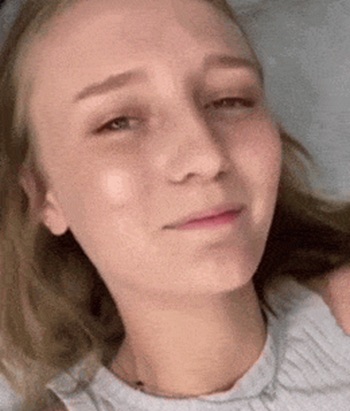 Девушка показала результат увеличения губ